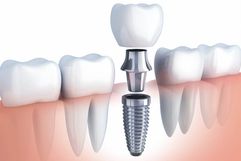 Implants Dentist in River Forest